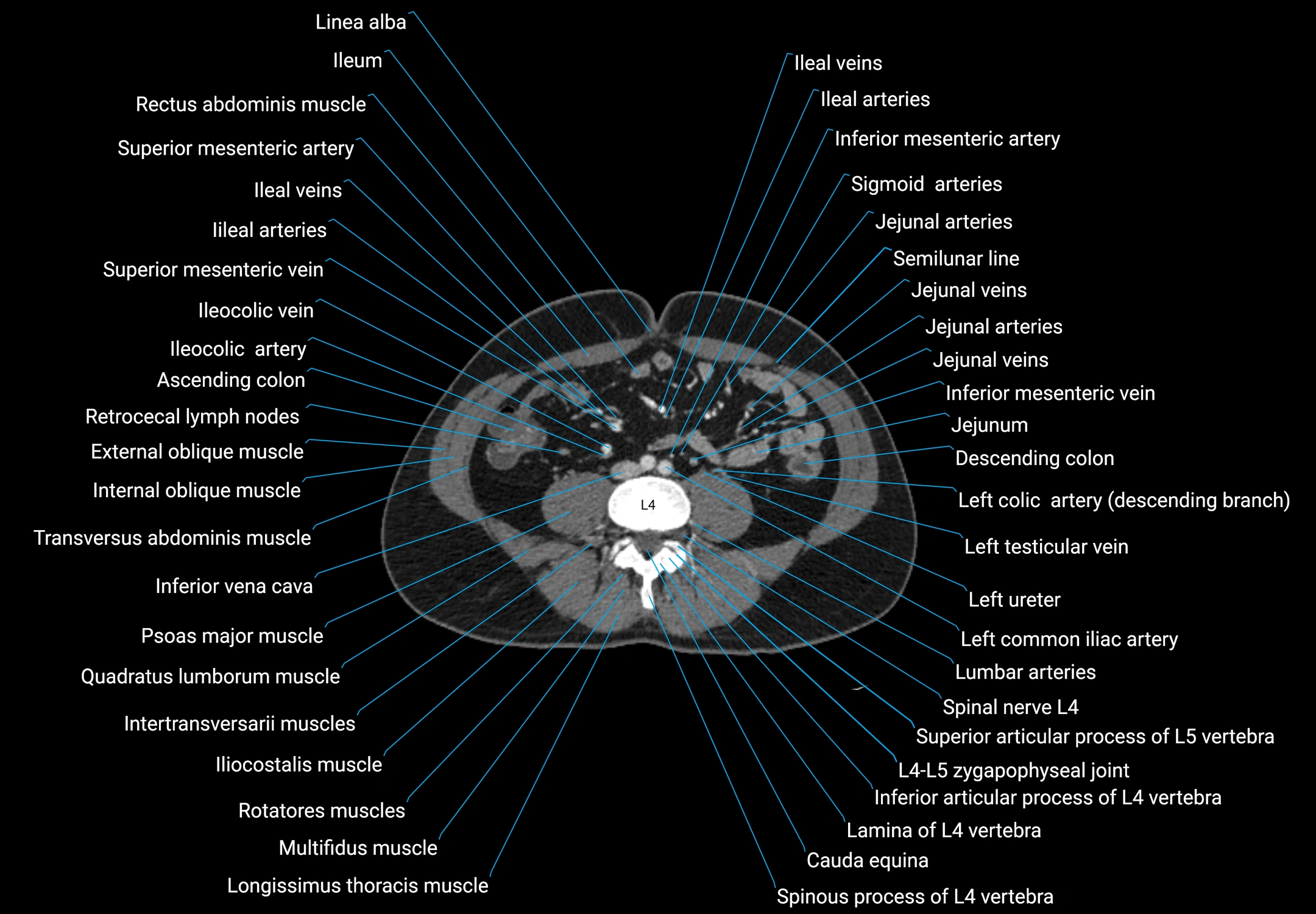 CT male pelvis axial cross sectional anatomy labelled radiology image -00114.webp